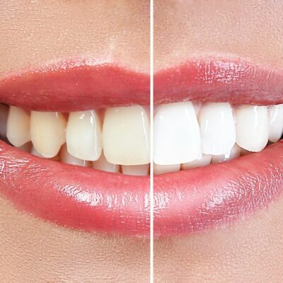 Carmel Dentistry Before and After