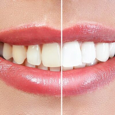Carmel Dentistry Before and After Carmel Dentistry Before and After