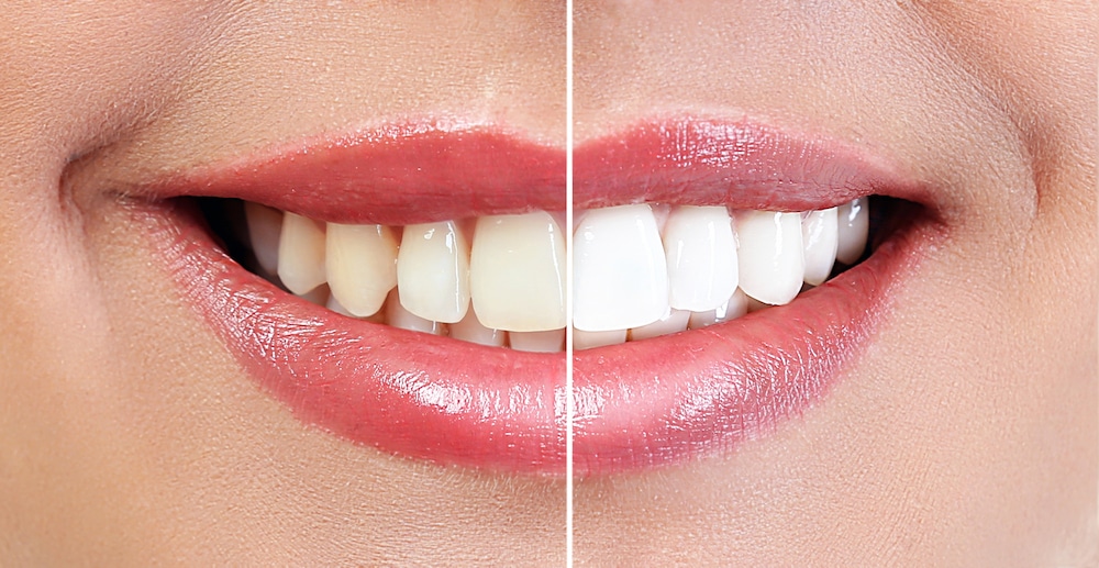 Carmel Dentistry Before and After