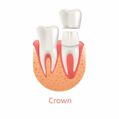 DENTAL CROWNS near Carmel Indiana