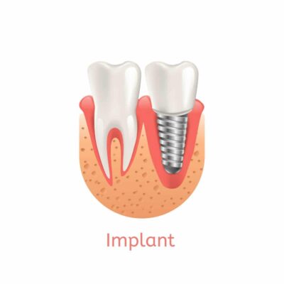 Dental Implants Restorations Carmel Indiana