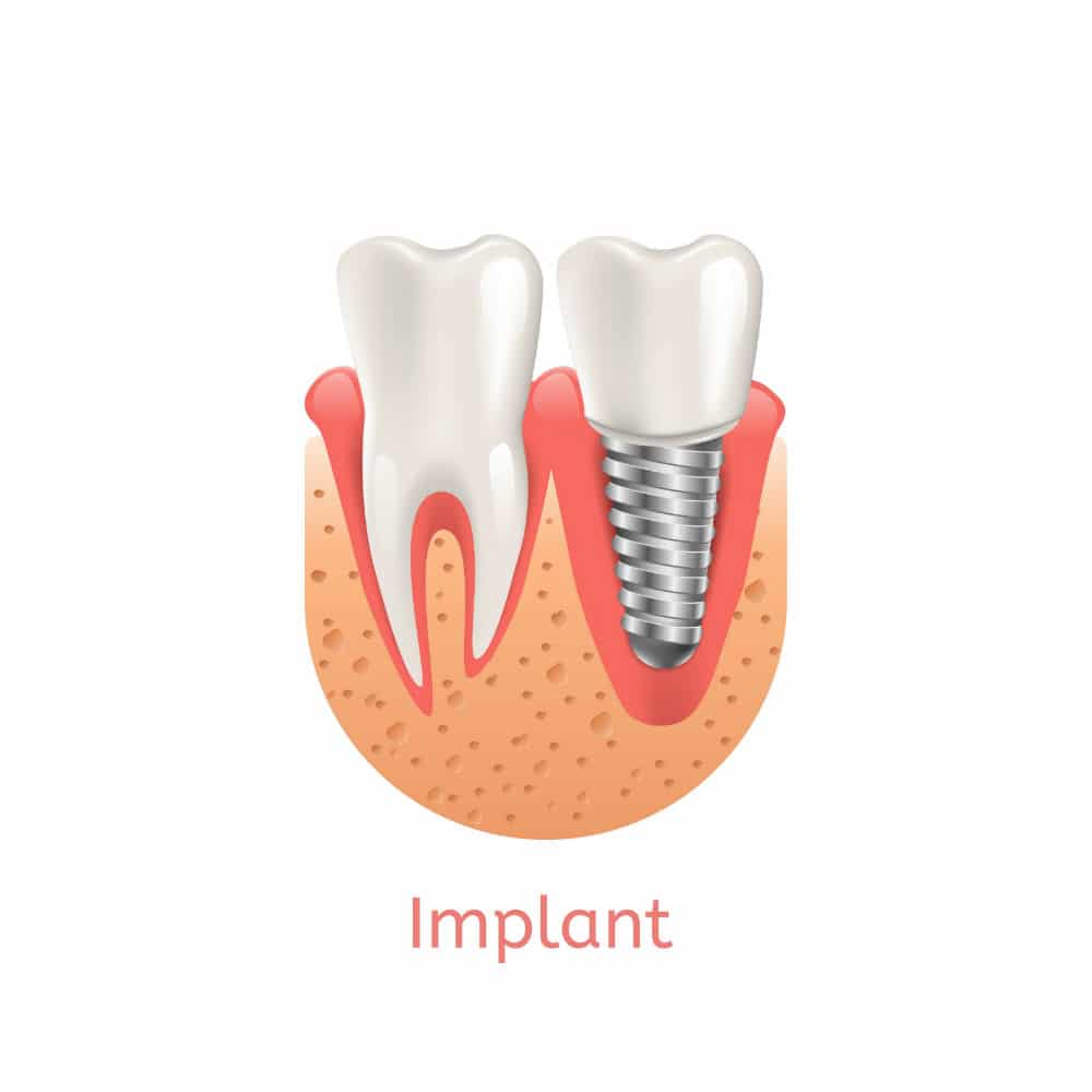 Dental Implants Restorations Carmel Indiana Dental Implants Restorations Carmel Indiana