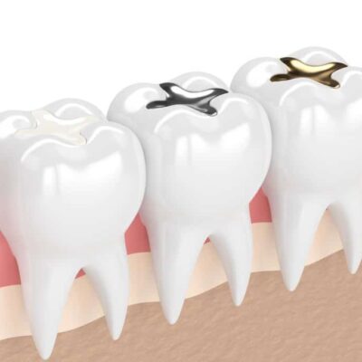 Fillings for Cavities in Carmel IN