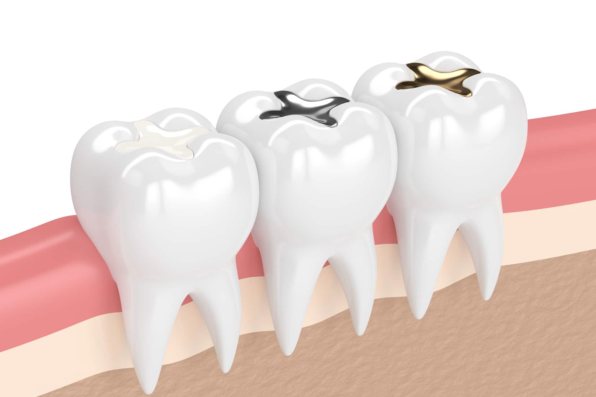 Fillings Dentist Carmel Indiana Fillings for Cavities in Carmel IN