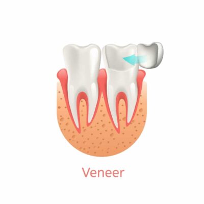 Veneers Carmel Indiana